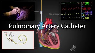 Pulmonary artery catheter SwanGanz Catheter placement and physiology [upl. by Acinnej151]