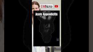 Acute Appendicitis [upl. by Sedecrem]