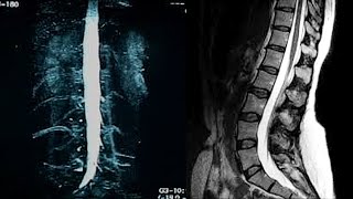 MR Myelogarhy technique فحص مايلوجرافي لفقرات الظهر [upl. by Stavros]