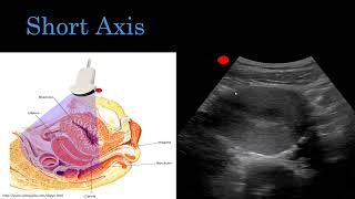 PoCUS 1st Trimester OB Transabdominal [upl. by Halbeib473]