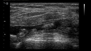 Chronic Synovitis Knee Joint  Effusion Joint  Hypertrophid Synovial [upl. by Dnalyk]