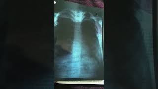 Normal chest Xray xray bscnursing newsong [upl. by Evetta]