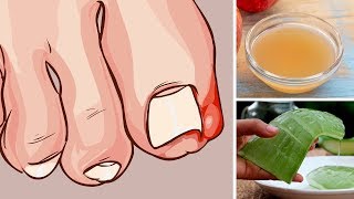 5 Home Remedies for Ingrown Toenails That Really Work [upl. by Elle]