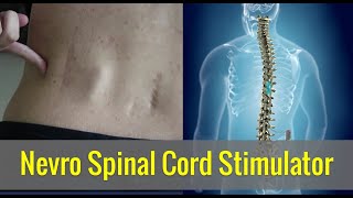 What does the Nevro Spinal Cord Stimulator scar look like  Young Chronic Pain [upl. by Filberto]