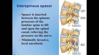 Lumbar Spinal Stenosis  Diagnosis and Treatment Options [upl. by Jose]