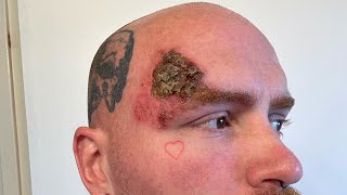 End Of Week 6 Superficial Basal Cell Carcinoma Skin Cancer Aldara Treatment [upl. by Ball]