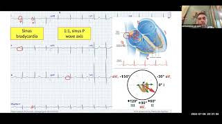 Arrhythmia Lectures Bradycardia  By Dr Mohamed Ibrahim [upl. by Watt]