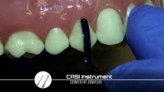 Class V Restoration by Dr Carlos Sanchez [upl. by Gnay]