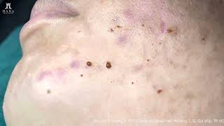 Big Cystic Acne Blackheads Extraction Blackheads amp Milia Whiteheads Removal Pimple Popping shorts [upl. by Ahselet]