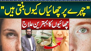 Melasma Treatment at Home  Melasma Cream and Melasma Home Remedies  Face Par Chaiyan Ka Ilaj [upl. by Ondrea]