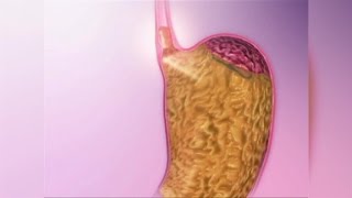 Acid Reflux Natural Remedies [upl. by Berlauda]