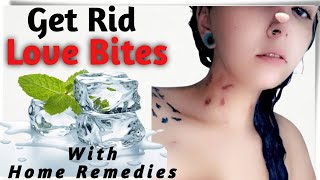 How to Remove Love Bite Marks Instantly  How to Get Rid of a Hickey  Home Remedies for Kiss Marks [upl. by Norton639]