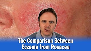 The Comparison Between Eczema from Rosacea [upl. by Sdlonyer]