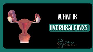 WHAT IS HYDROSALPINX [upl. by Ahsiei]