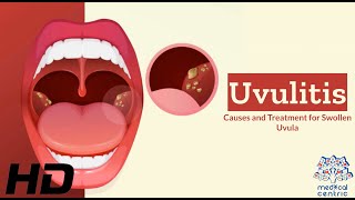 Uvulitis Explained Whats Causing Your Swollen Uvula [upl. by Conlee225]