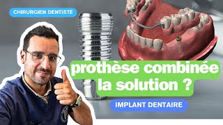 Dents mobiles  les implants dentaire pour stabiliser un appareil [upl. by Jew107]