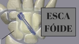 Cirurgia Escafoide com Anestesia Local [upl. by Suirtemid]