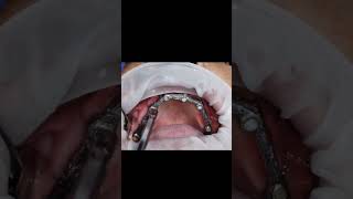 Avoiding zygomatic dental implant surgery by 3BTi B protocol post 6 months healing statusshorts [upl. by Edaj998]