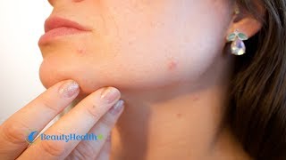 How to Use Sudocrem for Acne [upl. by Seldon]