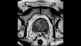 High resolution Prostate MRI [upl. by Areema]