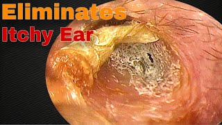 The Itching Stopped after Removing Earwax  Doctor Anh [upl. by Yemaj]