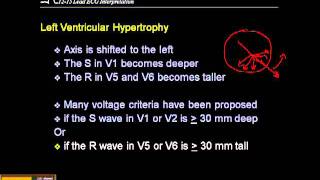 1215 Lead ECG Ventricular Hypertrophy [upl. by Bullivant]