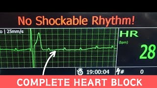 Third Degree AV Block  Complete Heart Block on Hospital Monitor cardiology [upl. by Nimzzaj918]