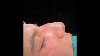 structural rhinoplasty  lateral crural overlay educationreal time [upl. by Nnilsia]