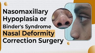 Nasal Correction in Nasomaxillary Hypoplasia  Nose correction Surgery in Delhi  Dr PK Talwar [upl. by Acined611]