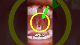 N’AVALEZ JAMAIS UNE DENT 🦷😨 shorts viral youtubeshorts [upl. by Airbas]