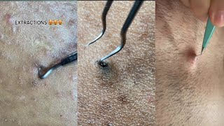 ingrown hair removal Completion 😌 2023 Edition [upl. by Etheline]