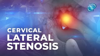 What is Cervical Lateral Stenosis  Foraminal Stenosis [upl. by Naamann]