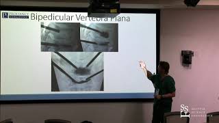 Vertebral Augmentation Pedicular Approach  Neal H Shonnard MD [upl. by Howie304]