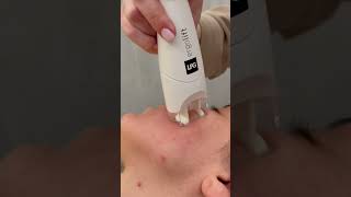 LPG Facial london skincare [upl. by Souvaine651]