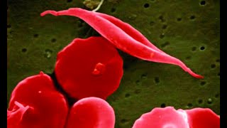 Enfermedad de células falciformes un tipo de anemia hemolítica potencialmente grave [upl. by Heimer]