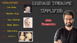 Digeorge Syndrome  Etiopathogenesis Clinical FeaturesDiagnosis and Management [upl. by Regdirb]