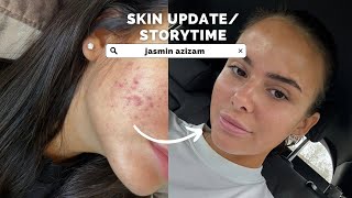 VLOG Skintalk Erfahrung mit der Pille Hormonelle Akne   Jasmin Azizam [upl. by Bette-Ann]