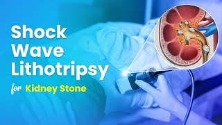 Shock Wave Lithotripsy ESWL for Kidney Stone Treatment  3D Guide [upl. by Rattray]