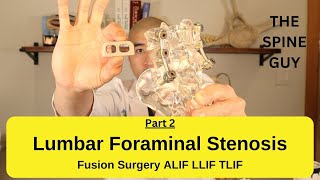 Lumbar Foraminal Stenosis  Fusion Surgery Options Part 2 [upl. by Alrad675]