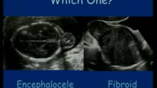 Ultrasound Congenital Anomalies  fetal medicine  fetus [upl. by Attaymik]