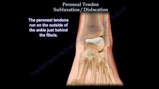 Peroneal Tendon Subluxation  Dislocation  Everything You Need To Know  Dr Nabil Ebraheim [upl. by Etnahsa819]