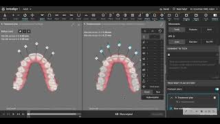 Avoid palatal root torque if you dont need it [upl. by Dam]