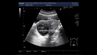 Two cases of Hemorrhagic Ovarian Cyst [upl. by Bausch]