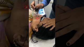 Laser treatment for pigmentation Laser toning  stubborn pigmentation treatment lasertreatments [upl. by Zednanreh]