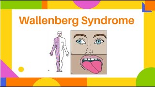 Wallenberg Syndrome  Lateral Medullary Syndrome  PhysiotherapyKnowledge [upl. by Ehtylb]