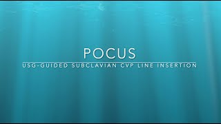 USG GUIDED Subclavian vein CVP Line insertion  infraclavicular approach long axis view  Part 1 [upl. by Eramal]