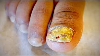 AMAZING TOENAIL FUNGUS amp FOOT RASH Tinea Unguium  Dr Paul [upl. by Nodnart]