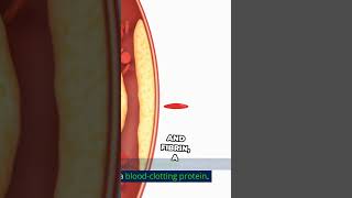 Atherosclerosis Causes and Solutions [upl. by Gnouhp]