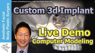 LIVE VIDEO CUSTOM FACIAL IMPLANT CREATION 3D MODELING SESSION DR PHILIP YOUNG SEATTLE  BELLEVUE WA [upl. by Reggie]