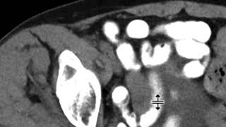 Appendix adenocarcinoma [upl. by Dollar]